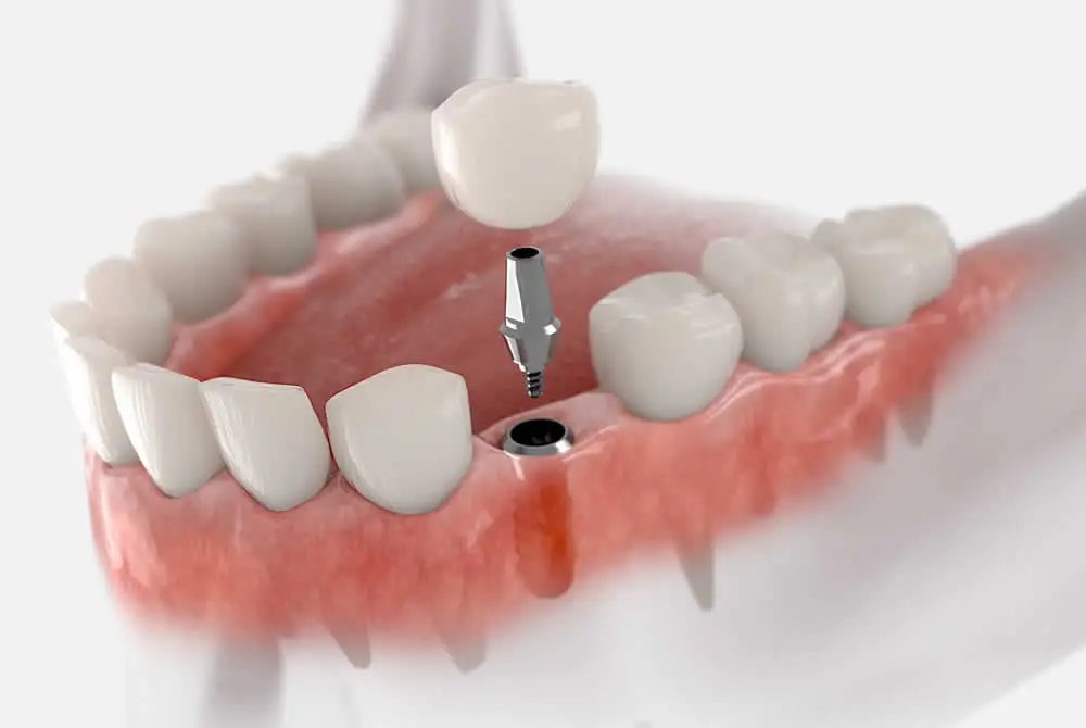 Single tooth implant