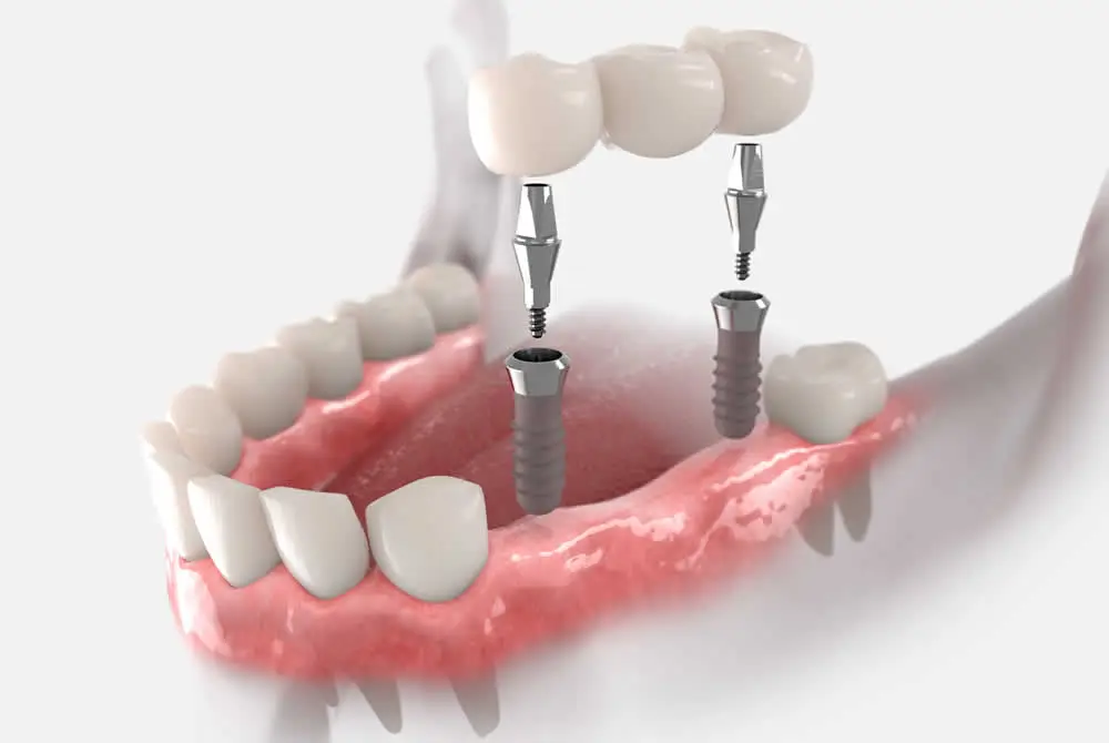 Implant Bridge