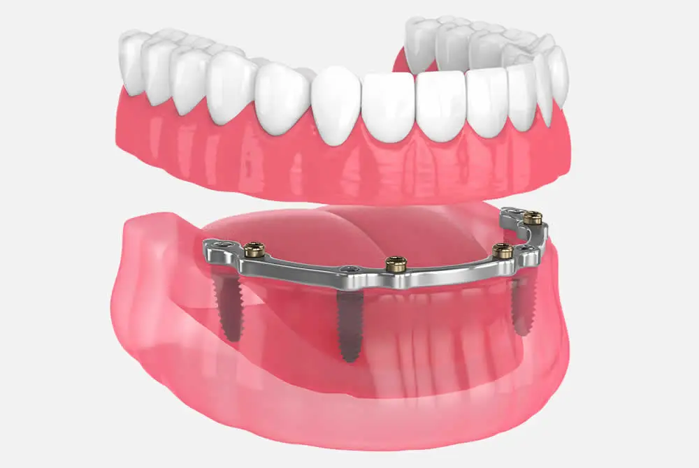 Implant-retained dentures